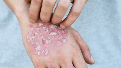 أحدث طرق علاج مرض الصدفية