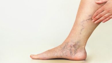 علاج دوالى الساقين بالأعشاب