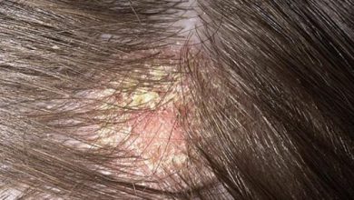علاج فطريات الشعر بالأعشاب والزيوت