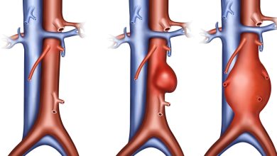 طريقة علاج الأبهر