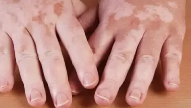 علاج البهاق بالأعشاب