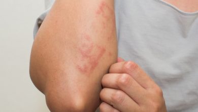 ما هي أنواع حساسية الجلد وما هي طرق العلاج الصحيحة لها