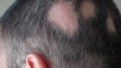 أفضل وصفة طبيعية لعلاج الثعلبة