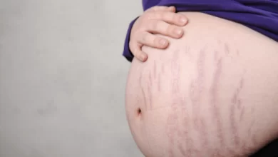 متى تظهر تشققات البطن عند الحامل وما هي طرق علاجها